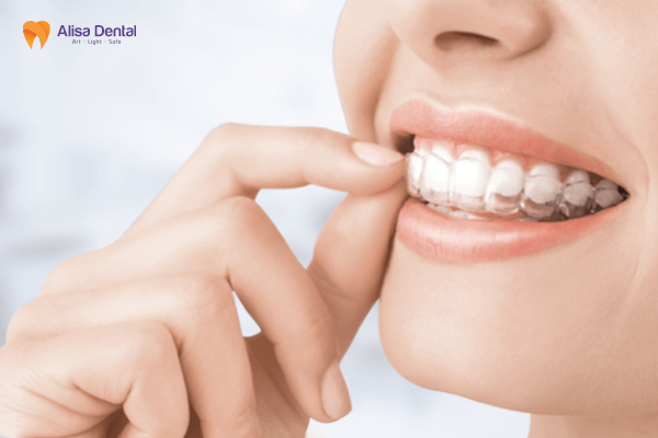Niềng Răng Invisalign