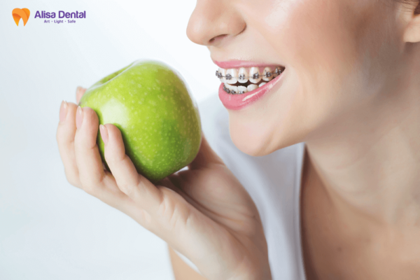 có nên niềng răng không