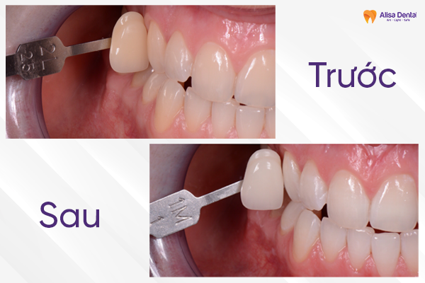 Quy trình tẩy trắng răng