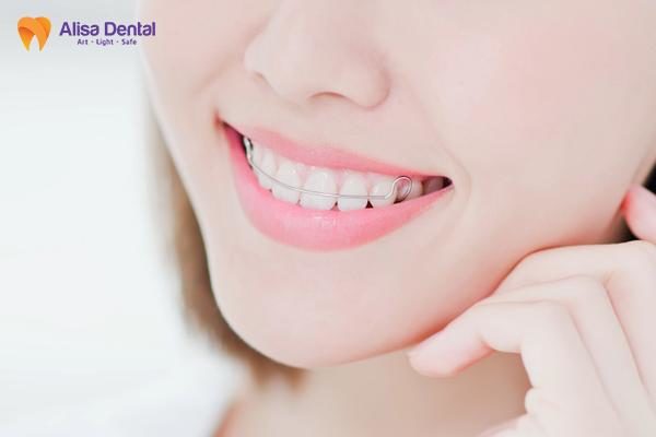 có phải đeo hàm duy trì cả đời không
