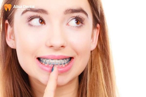 niềng răng có tác dụng gì