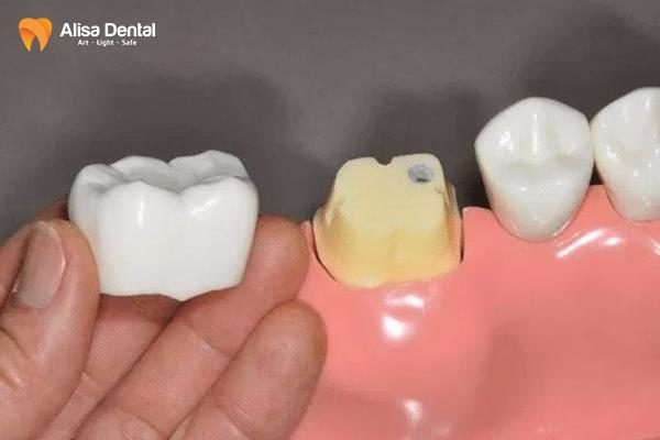 Bọc răng sứ hàm dưới 