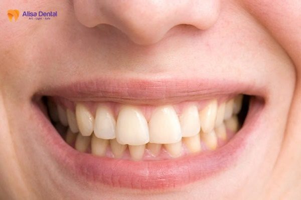Răng bị ố vàng do nhiều nguyên nhân khác nhau Nguyên nhân răng bị ố vàng, xỉn màu