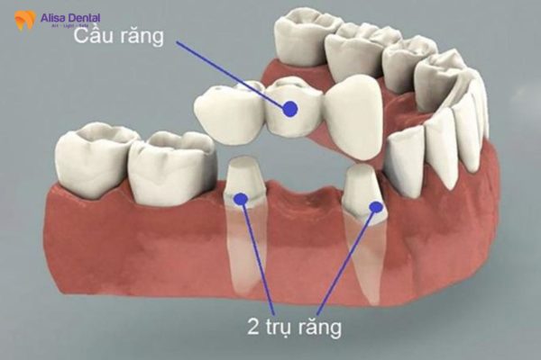 Trồng răng sứ có tốt không 