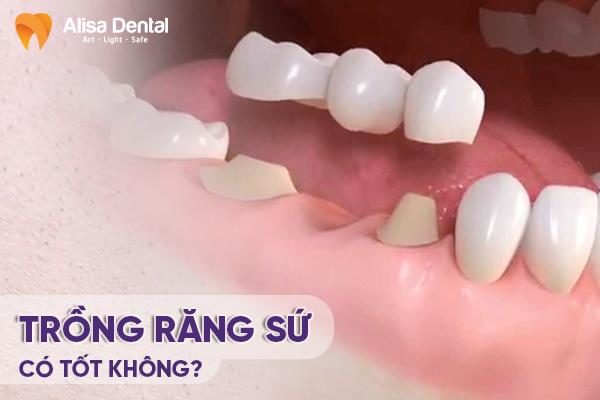 Trồng răng sứ