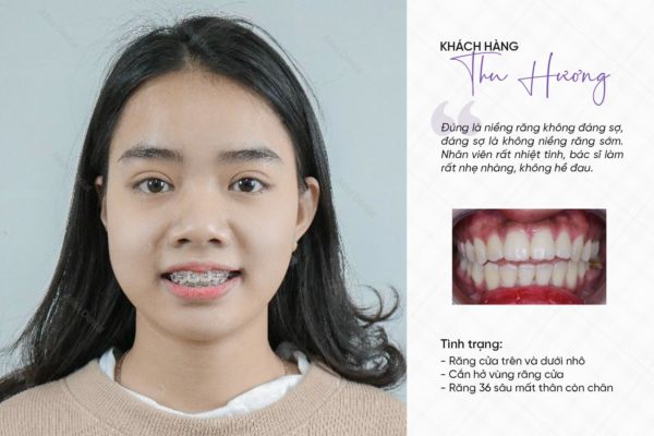 Khách hàng niềng răng kim loại thông minh tại Alisa