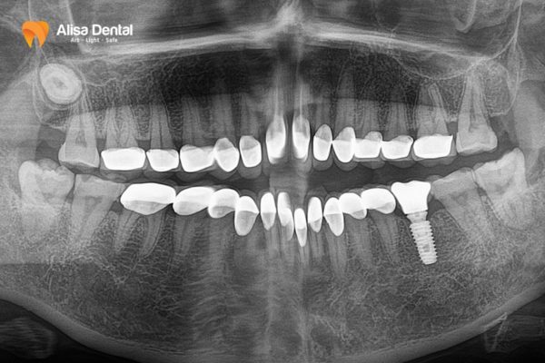 Trồng răng implant giữ được bao lâu