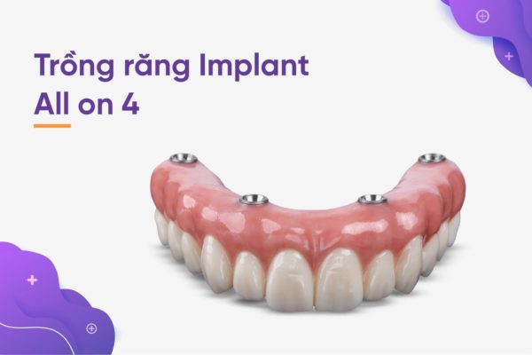 trồng răng Implant nguyên hàm