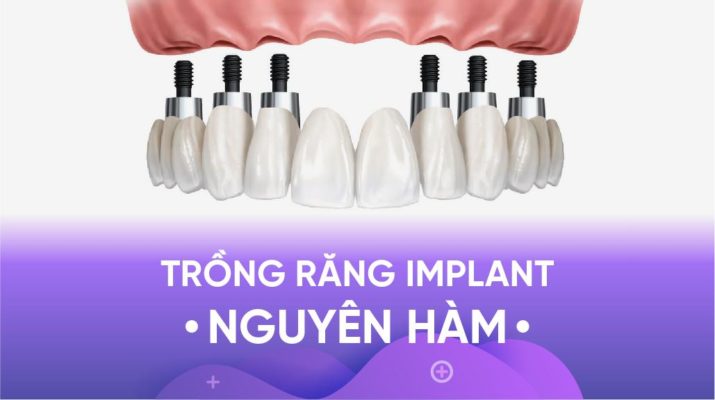 trồng răng nguyên hàm