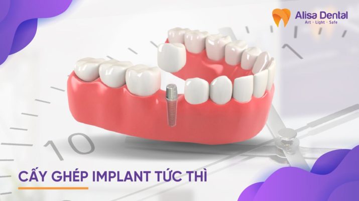 cấy ghép implant tức thì
