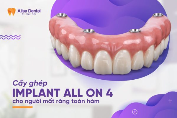 trồng răng toàn hàm