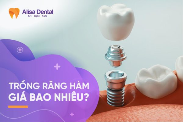 Giá trồng răng implant Hà nội