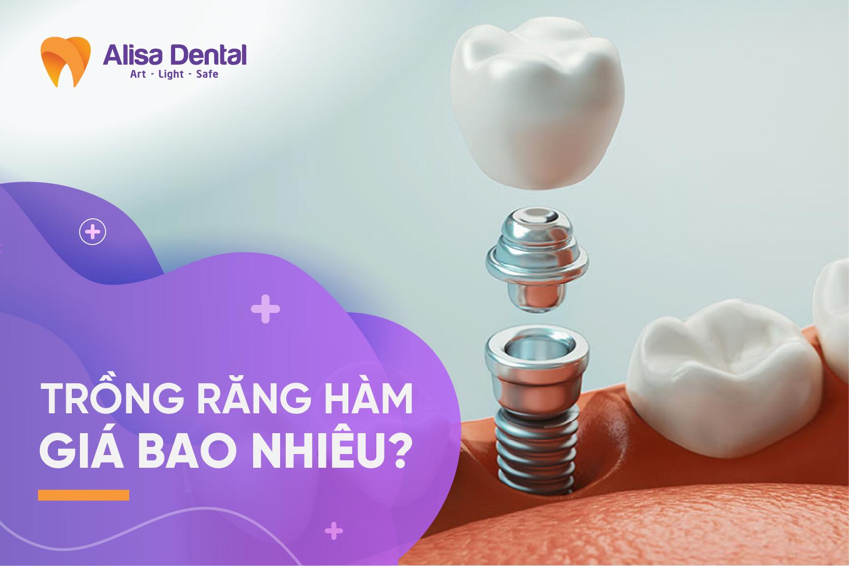 Giá trồng răng implant Hà nội