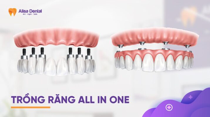trồng răng implant All on 6