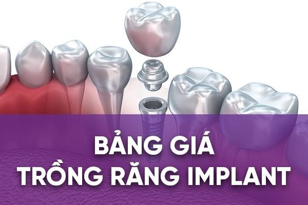 Bảng giá trồng răng Implant