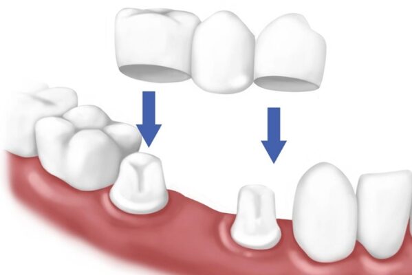 Làm Cầu Răng Sứ cải thiện mất răng hàm dưới