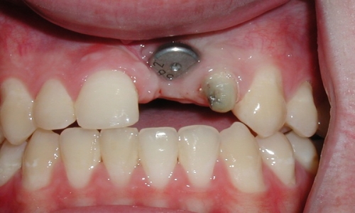 trồng răng implant giá rẻ