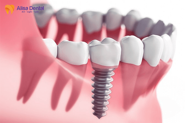 quy trình trồng răng implant