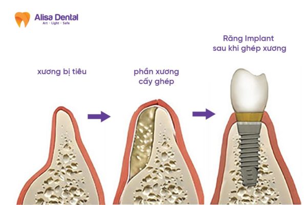 Trồng răng implant ghép xương là như thế nào?