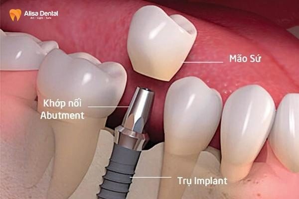 giá trồng răng implant ở Hà Nội