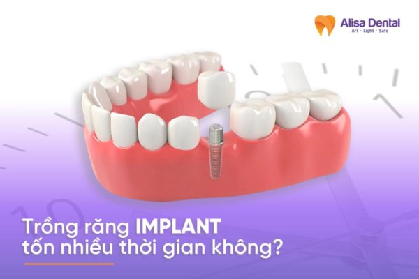 Thời gian trồng răng Implant