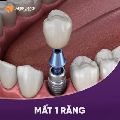 Trồng răng Implant 