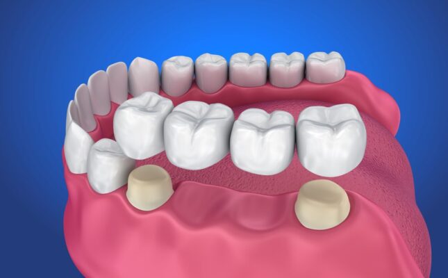 Các phương pháp phục hình răng đã mất