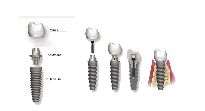 răng Implant giá bao nhiêu