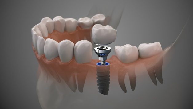 có nên trồng răng Implant không 