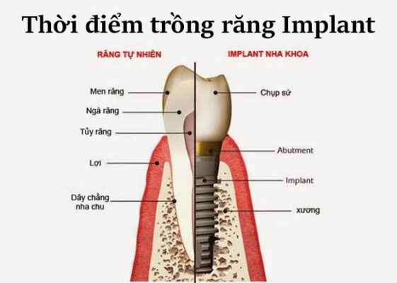 Kinh nghiệm trồng răng Implant