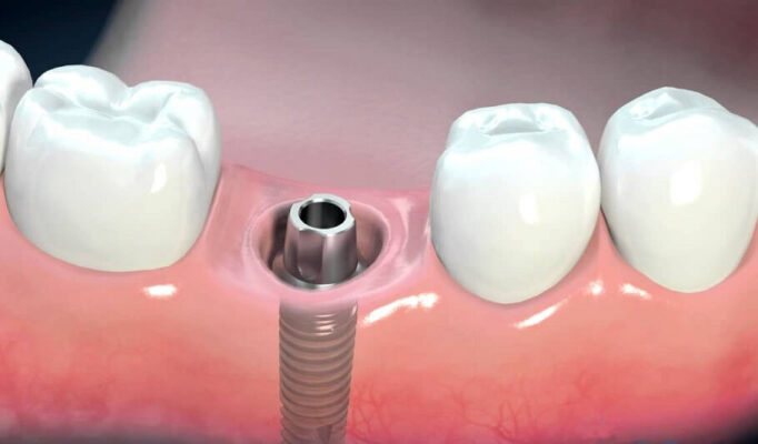 Kinh nghiệm trồng răng Implant
