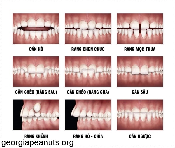 Bài Tập Cho Răng Hô: Phương Pháp Hiệu Quả Giúp Cải Thiện Nụ Cười