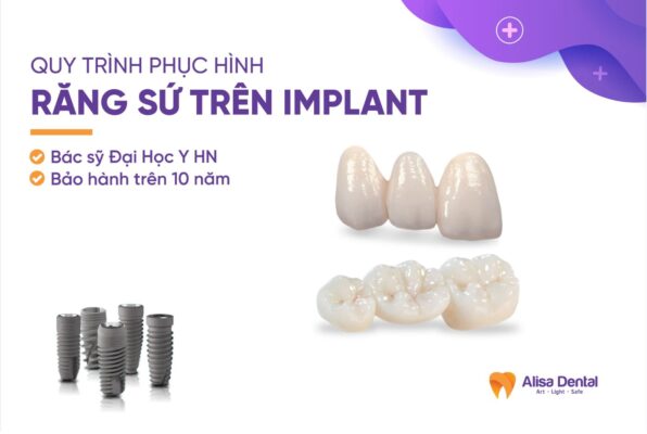 Răng sứ trên implant