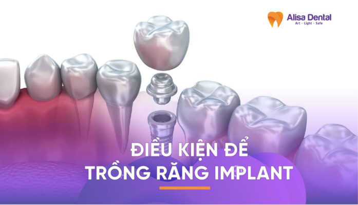 Điều kiện để trồng răng implant