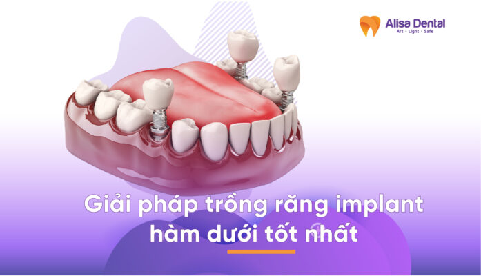 Giải pháp trồng răng implant hàm dưới tốt nhất