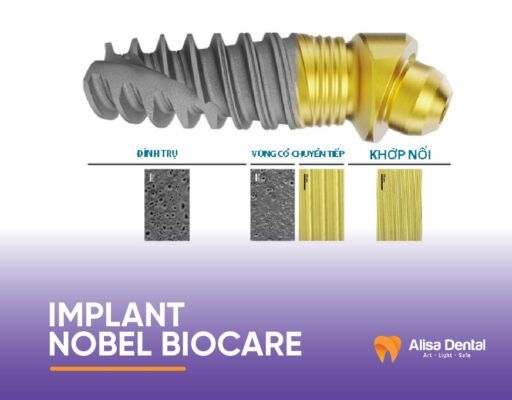 "Implant Nobel Biocare: Sự Lựa Chọn Vượt Trội Cho Răng Giả Hoàn Hảo"