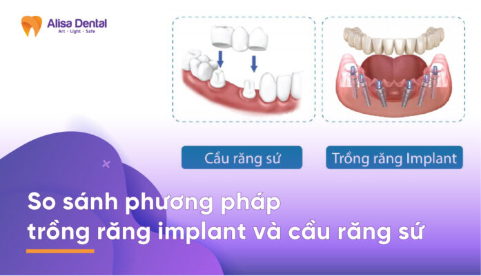 So sánh phương pháp trồng răng implant và cầu răng sứ