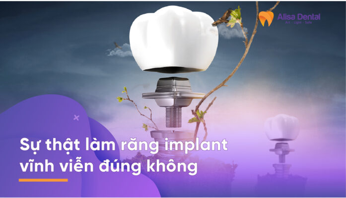 Sự thật làm răng implant vĩnh viễn đúng không