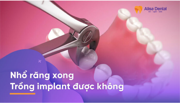 nhổ răng xong trồng implant được không