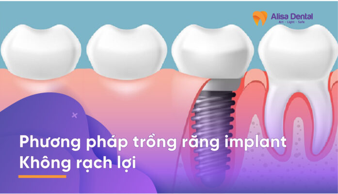 trồng răng implant không rạch lợi