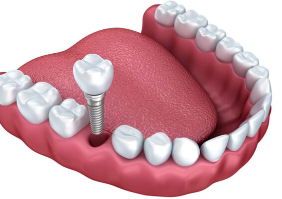trồng răng implant có an toàn không