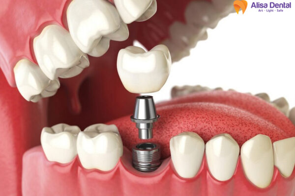 cấy ghép implant