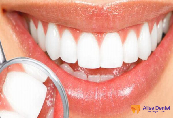 thẩm mỹ răng thỏ bằng composite