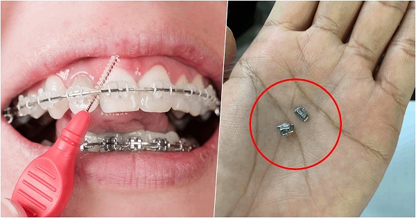 tự chỉnh mắc cài khiến niềng răng hỏng