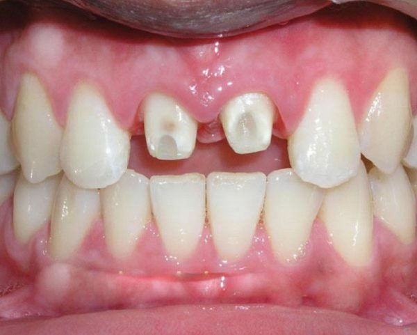 Dấu hiệu rơi răng sứ