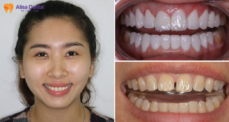 ưu điểm răng sứ emax