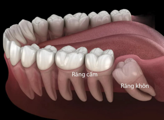 răng cấm