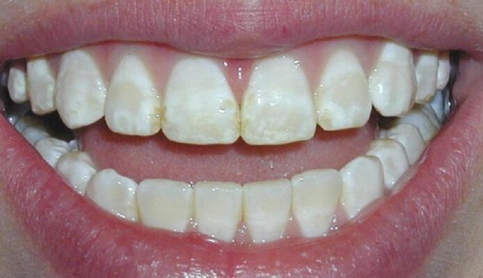răng không đều màu-niềng răng hỏng