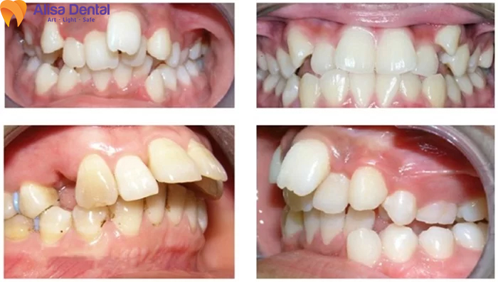 Trường hợp niềng răng khi Răng lệch lạc