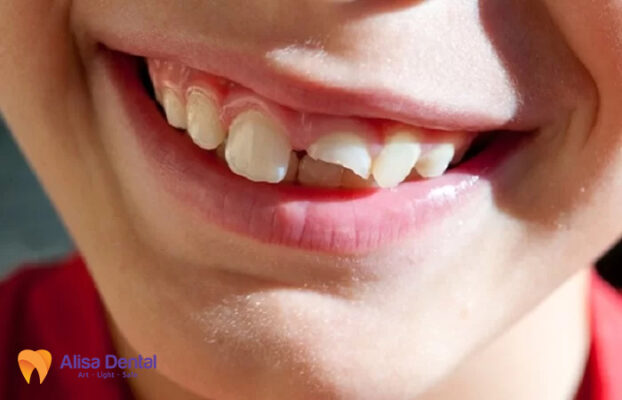 cấy ghép implant hà nội